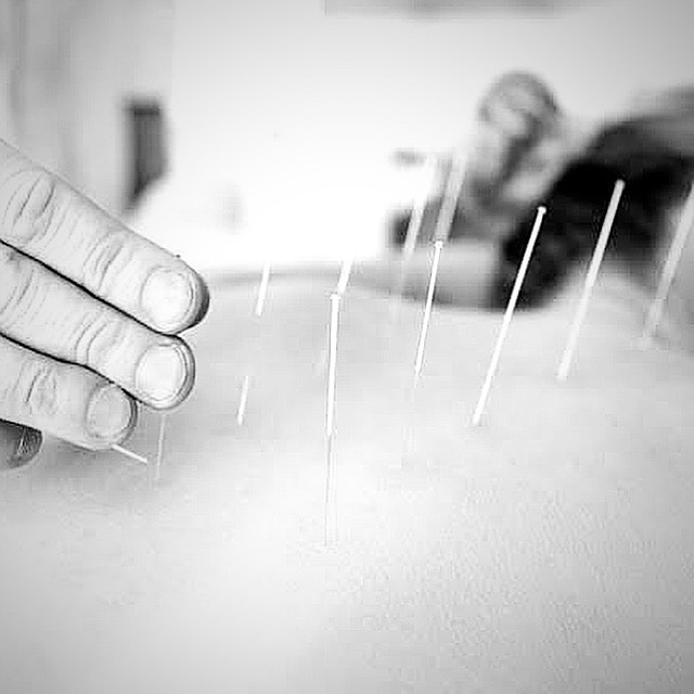 Dry Needling at The Physio House