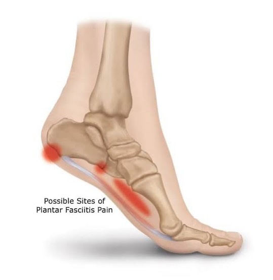 Understanding Plantar Fasciitis and How Physiotherapy Can Help