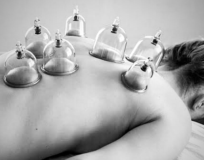 Cupping Therapy at The Physio House Townsville